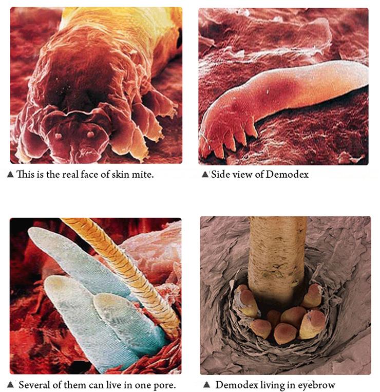 demodex