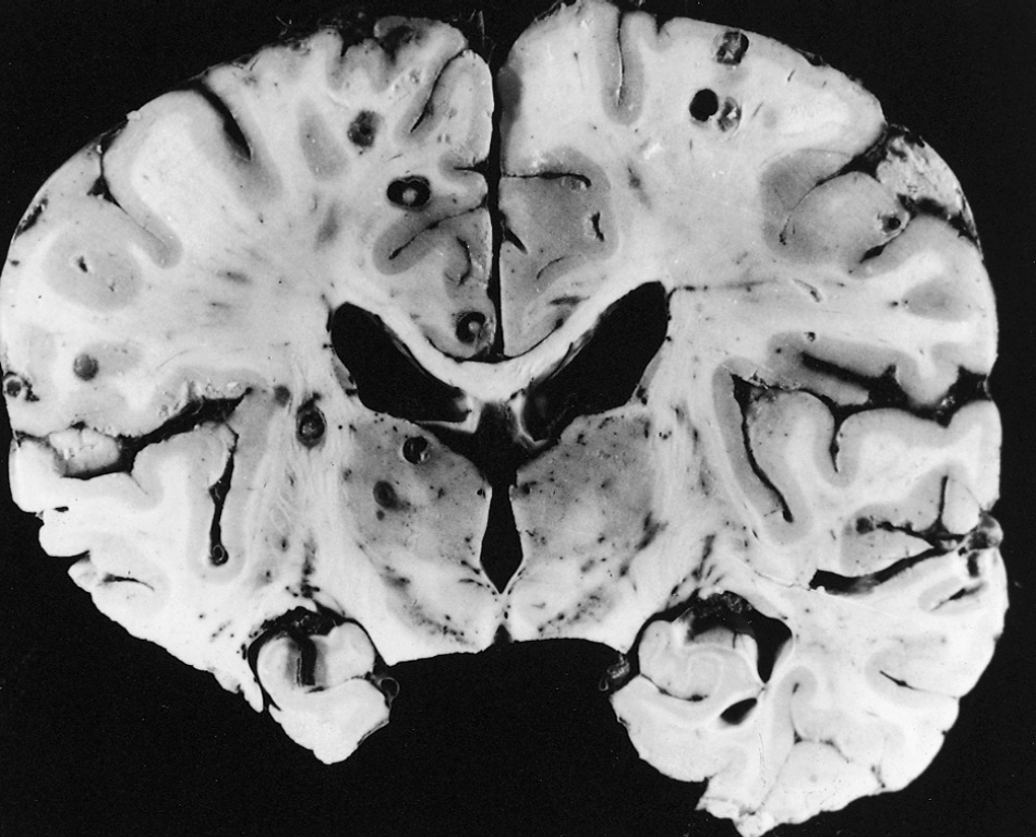 Third eye - Neurocysticercosis in a Mexican adult