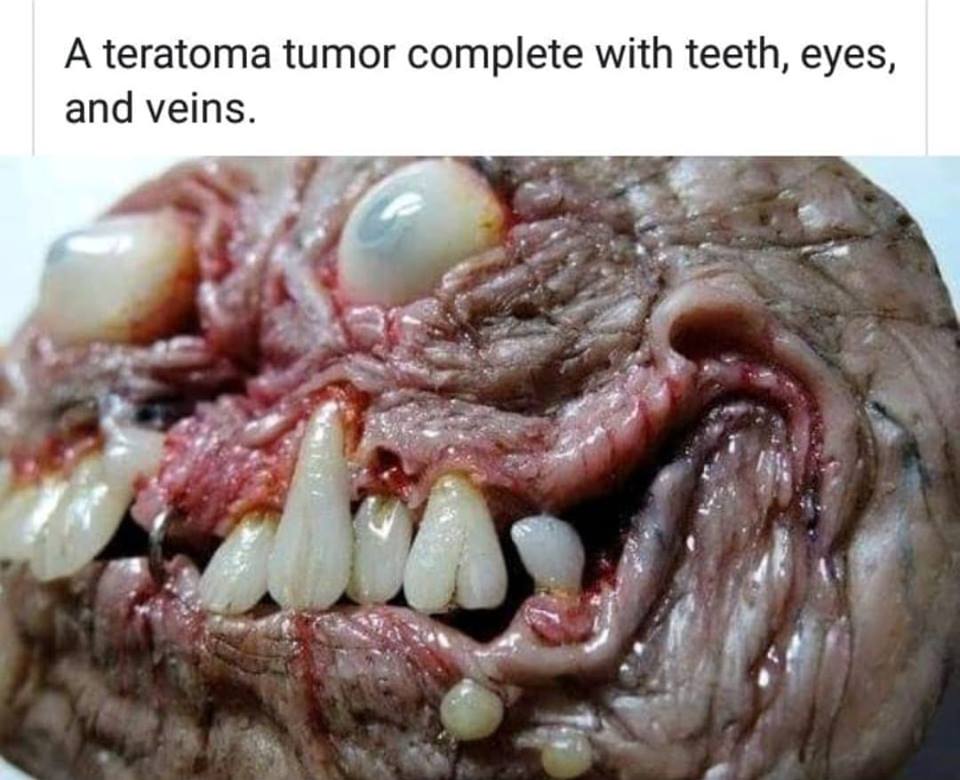 Tumor with eyes and teeth