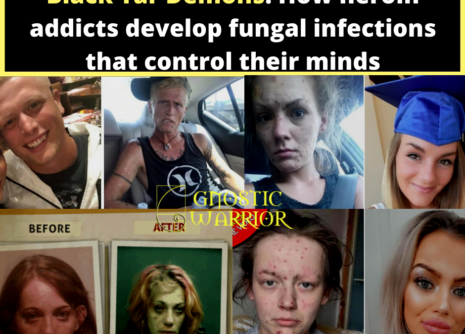 Black Tar Demons: How heroin addicts develop fungal infections that control their minds