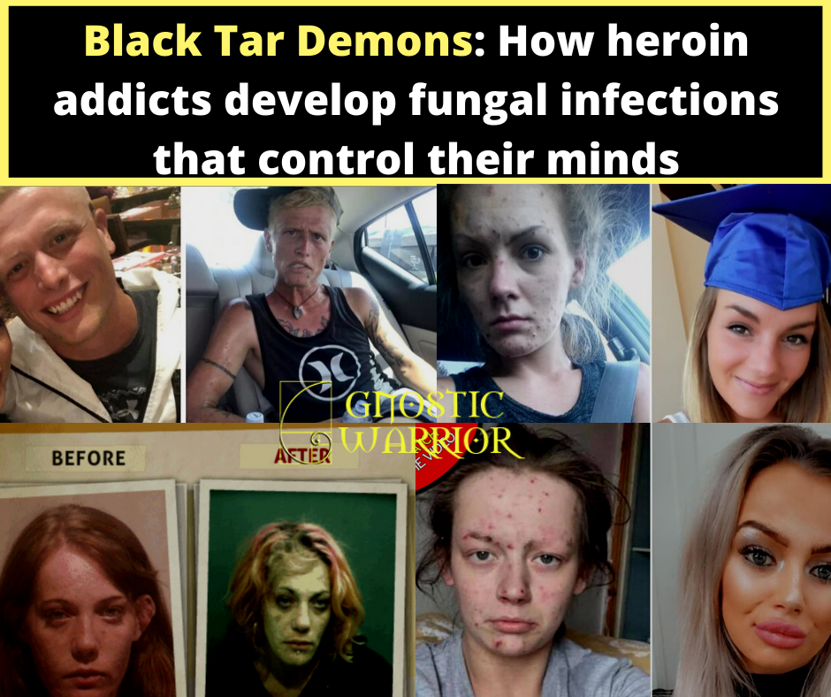 Black Tar Demons_ How heroin addicts develop fungal infections that control their minds